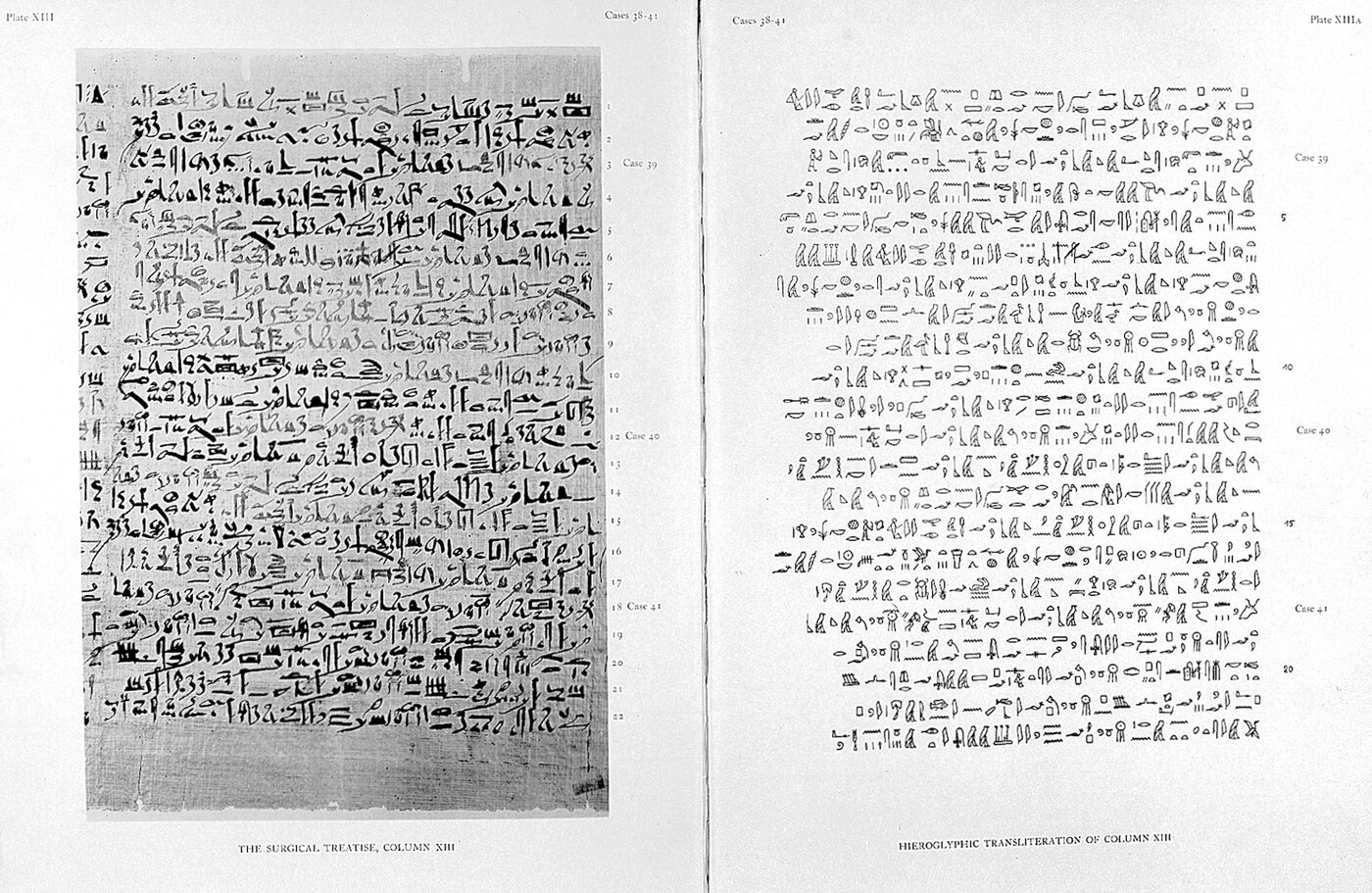 The Edwin Smith Surgical Papyrus, surgical treatise column with hieroglyphic transliteration