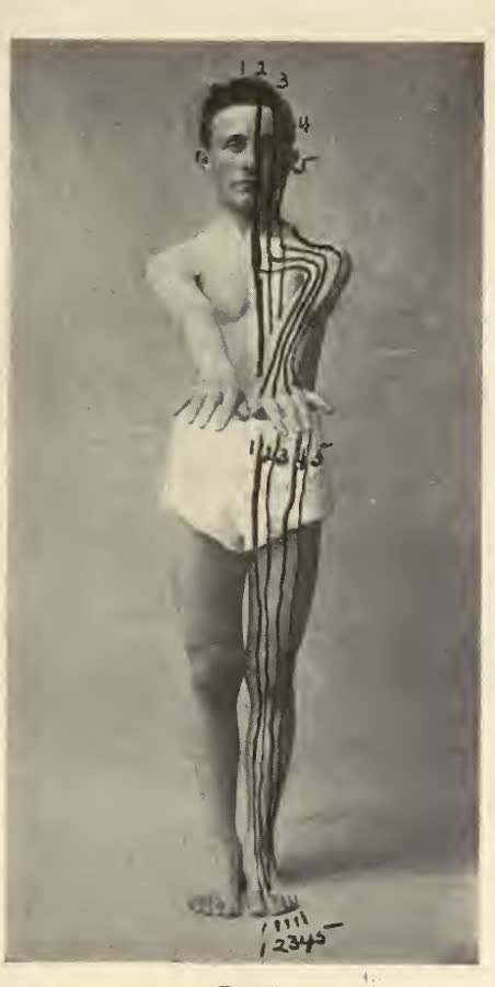 Fitzgerald's 1917 zone therapy chart — ten longitudinal zones drawn on a standing figure